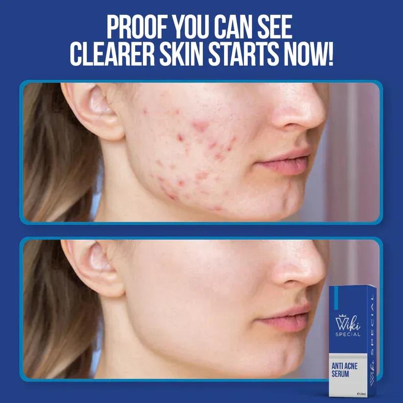 Wiki Special Anti Acne Serum – Clear & Smooth Skin (30ml)